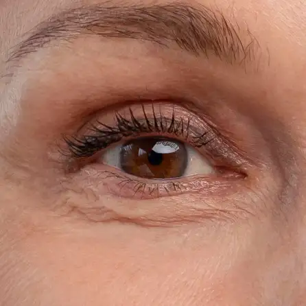 Después del tratamiento