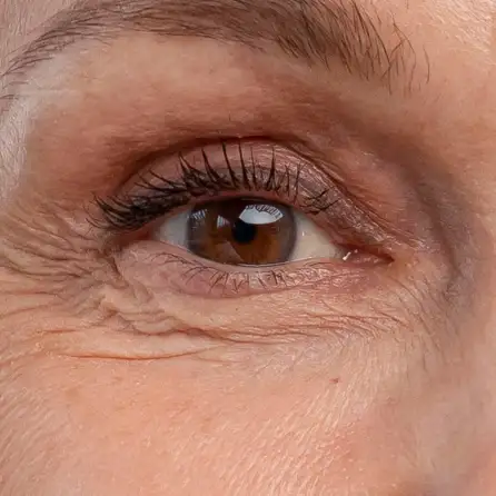 Antes del tratamiento